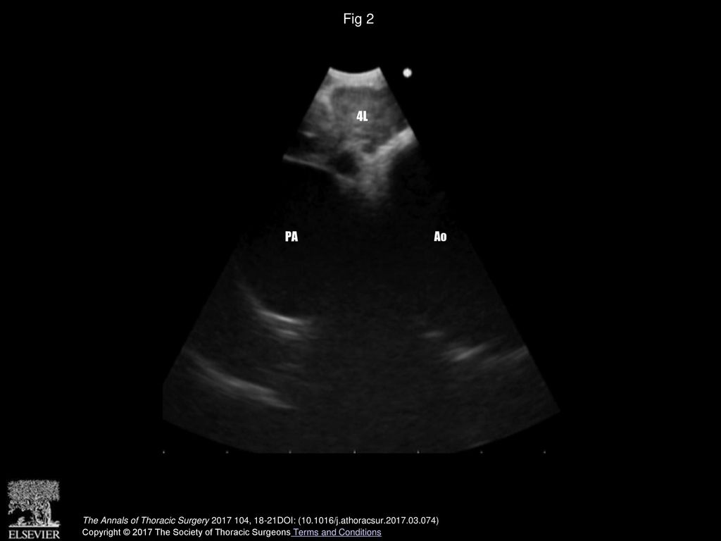 Fig 2 Left inferior paratracheal nodes (4L). (Ao = aorta; PA = pulmonary artery.)