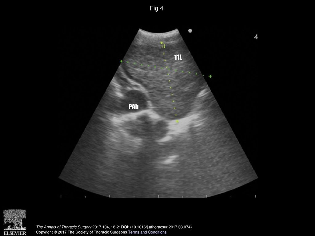 Fig 4 Left interlobar node (11L). (PAb = pulmonary artery branch.)