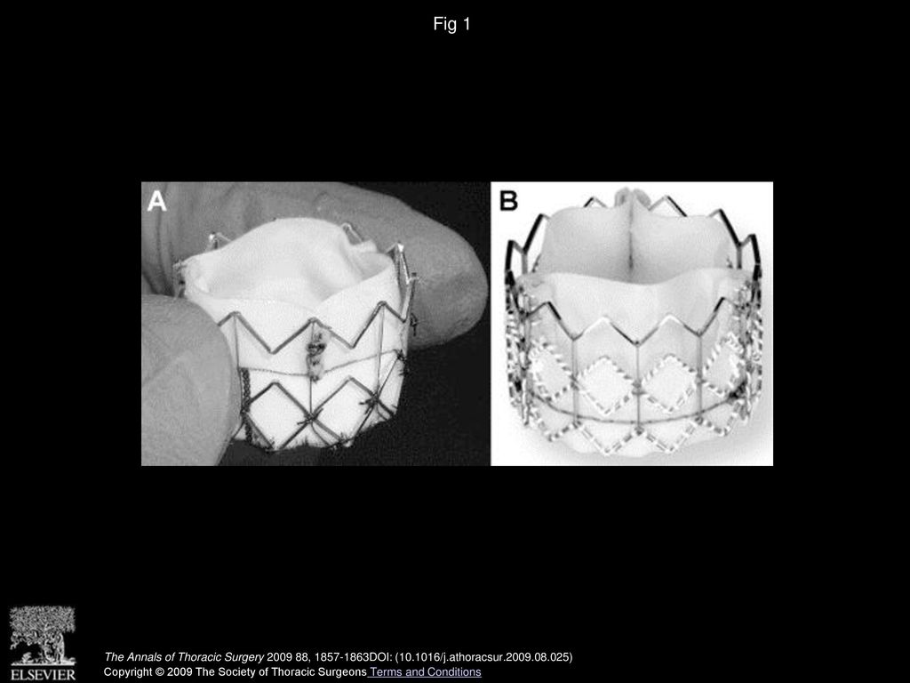 Fig 1 (A) Homemade 23 mm transcatheter aortic valve. (B) Edwards SAPIEN valve.