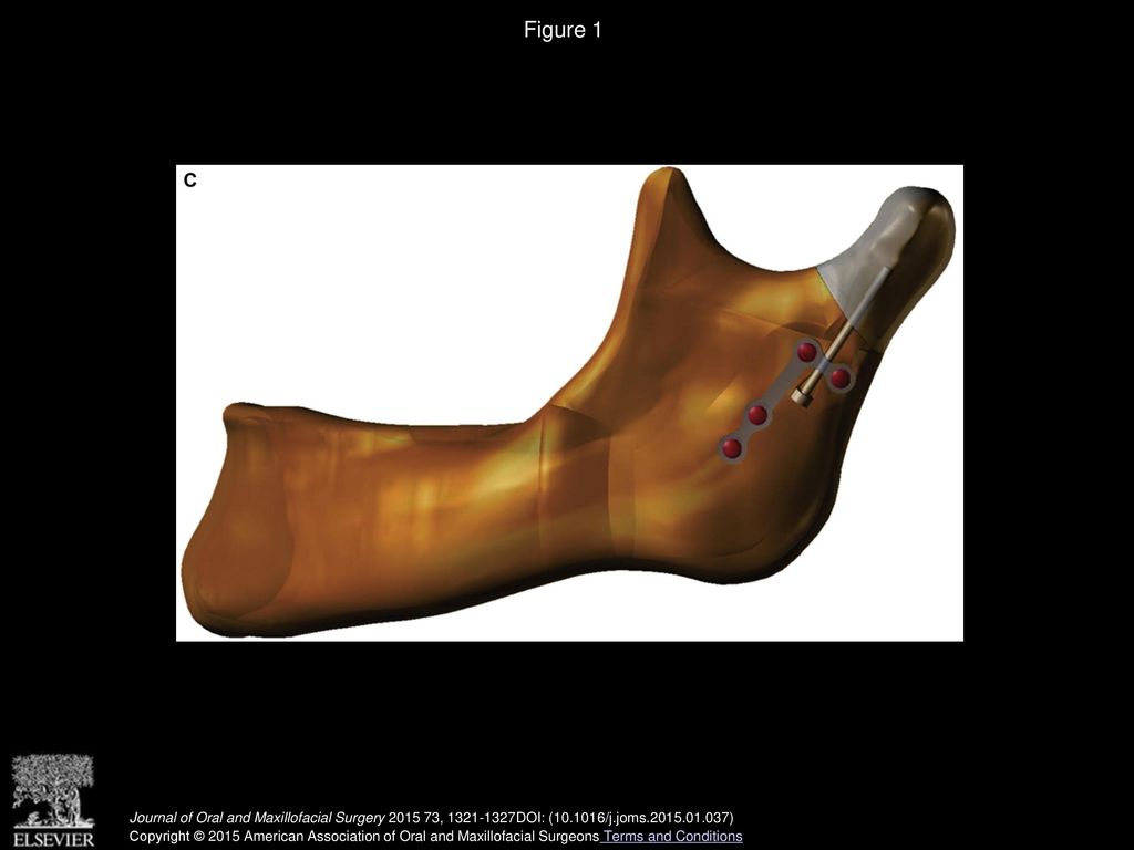 Figure 1 (A) One-miniplate system. (B) Two-miniplate system. (C) System using neck screw and L -shaped plate.