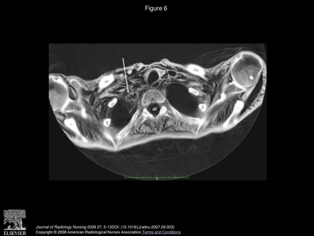 Figure 6 A lesion was noted in the right lung (arrow) measuring 1.96×1.11cm.