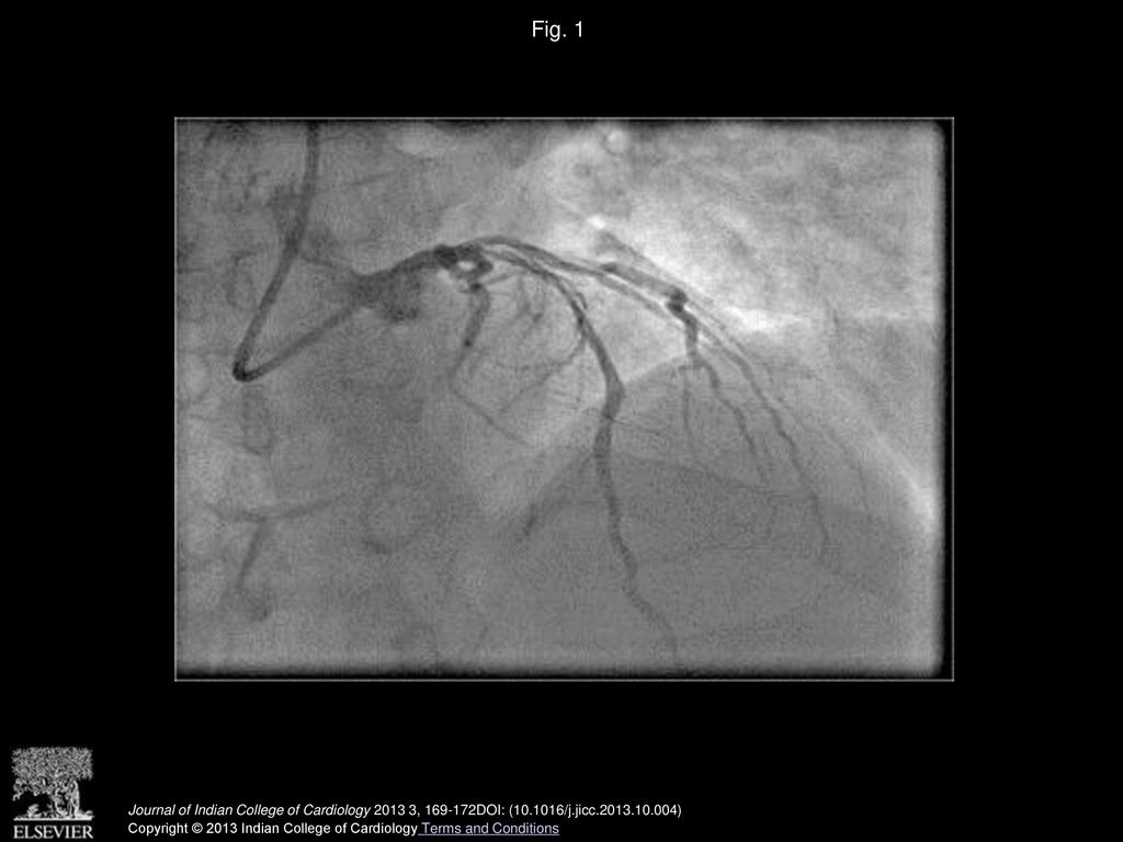 Fig. 1 Coronary angiogram showing the lesion in LAD and ramus.