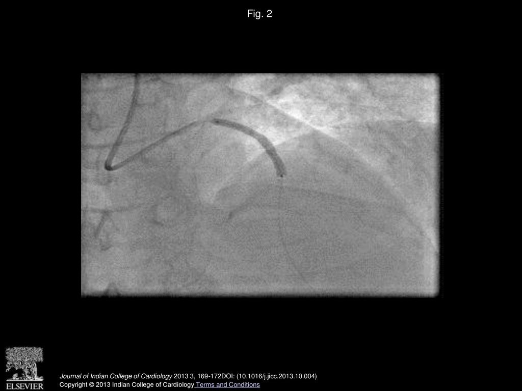 Fig. 2 Coronary angiogram showing the deployment of DES in LAD.