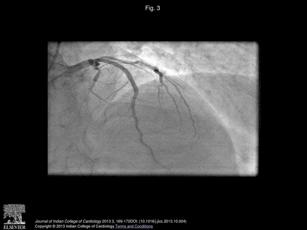 Fig. 3 Coronary angiogram showing achievement of TIMI 3 flow in LAD.
