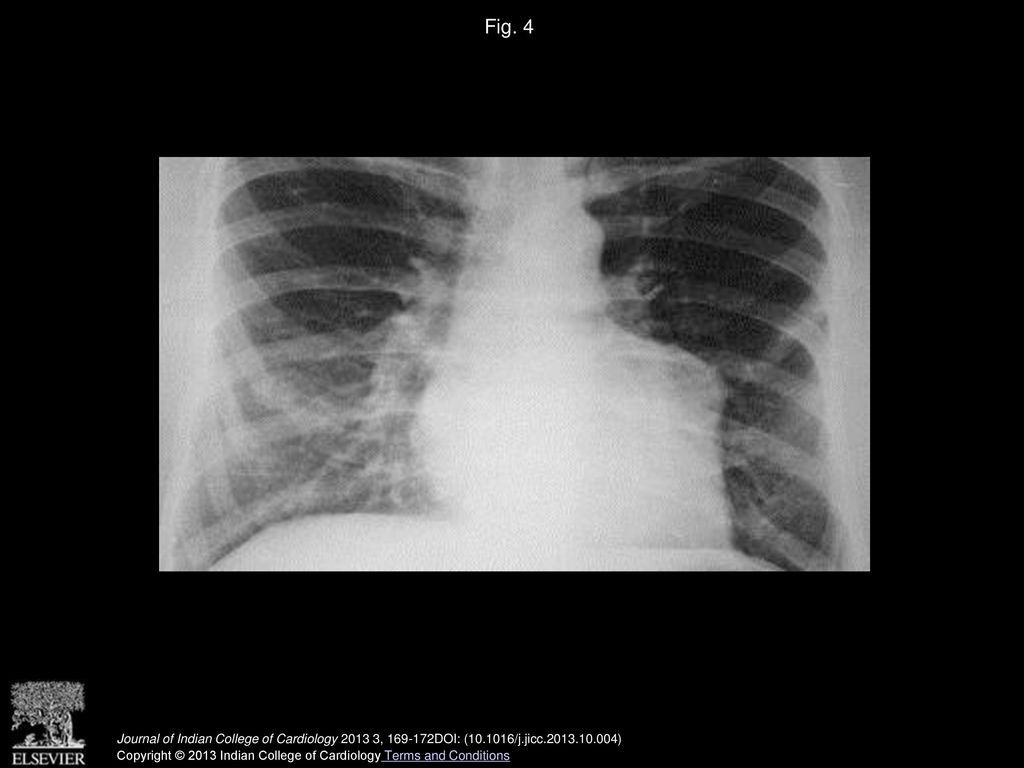 Fig. 4 Chest X-ray showing enlargement below the left atrial appendage.