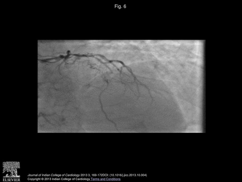 Fig. 6 Coronary angiogram showing grade 4 instent restenosis, neovascularization, and filling distal LAD with Collaterals.