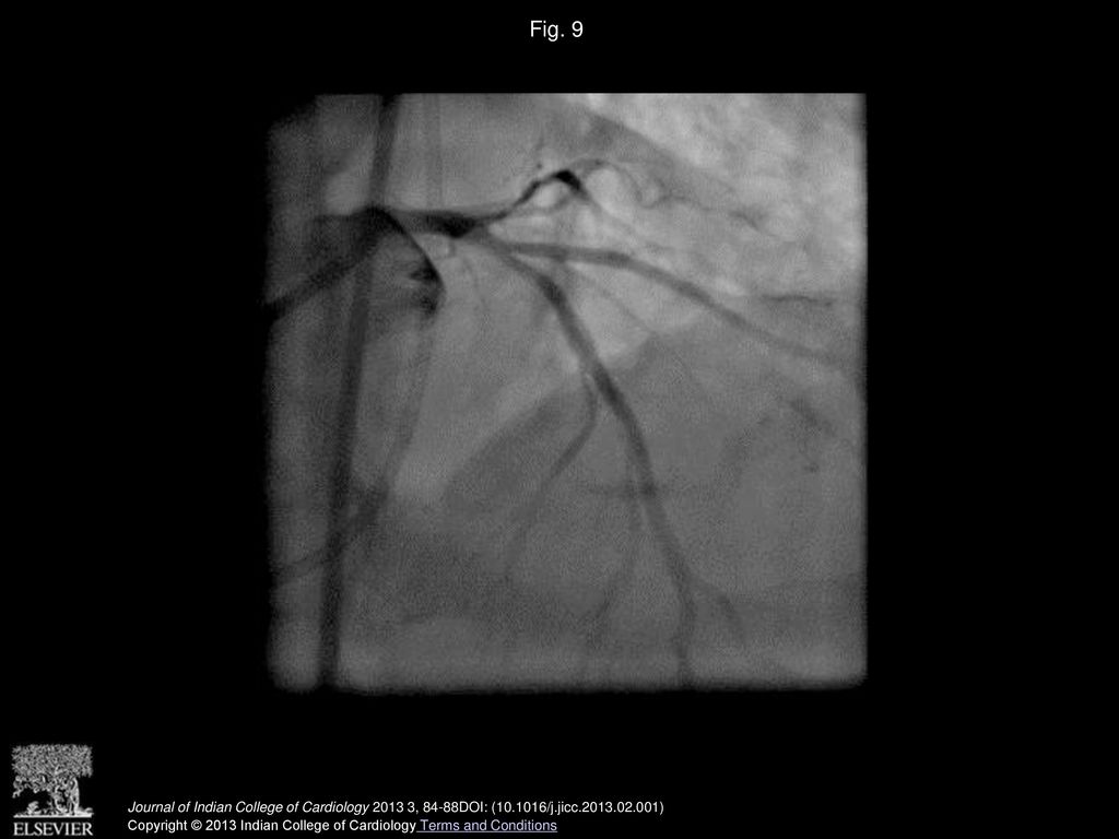Fig. 9 Final result after re-stenting of the Left main –