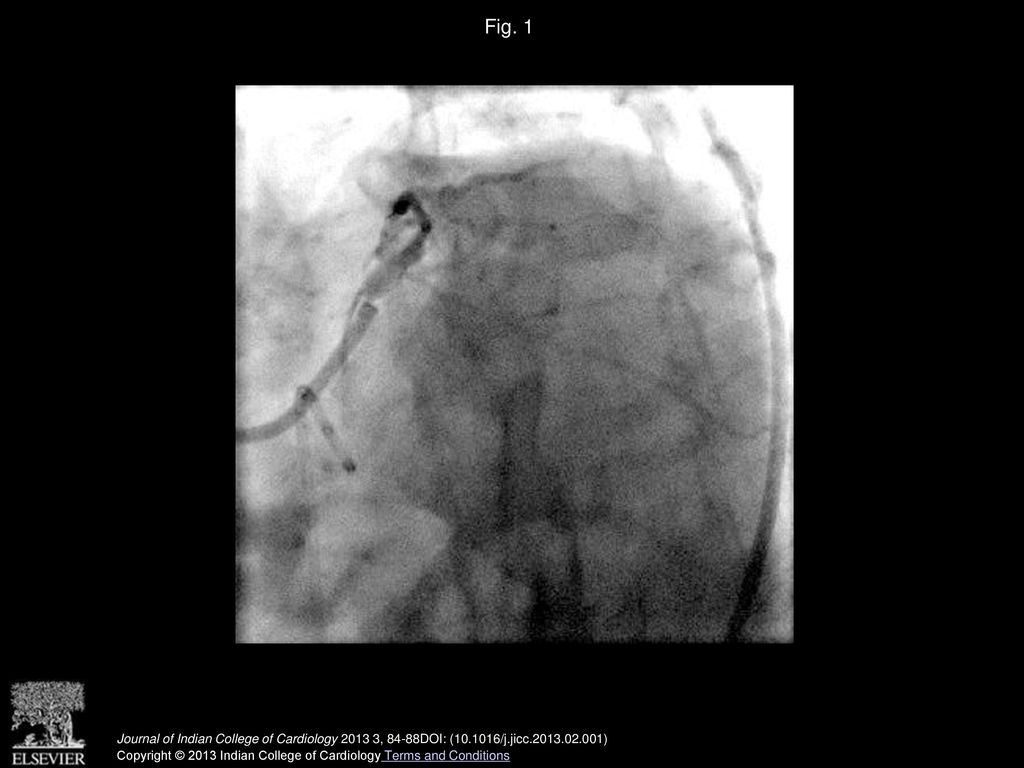 Fig. 1 Tight Left main ostial stenosis –