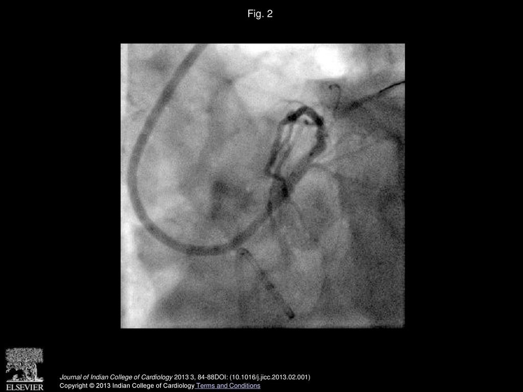Fig. 2 Post stenting of the Left main ostium –