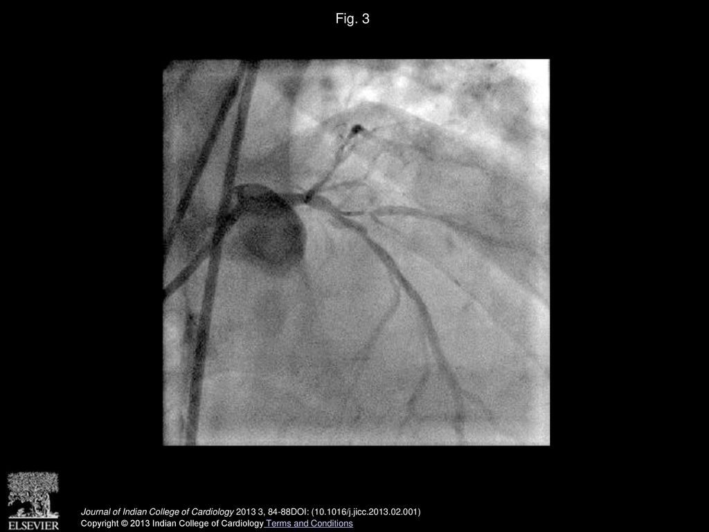 Fig. 3 Bifurcation lesion of the LAD and dg – pre stenting –