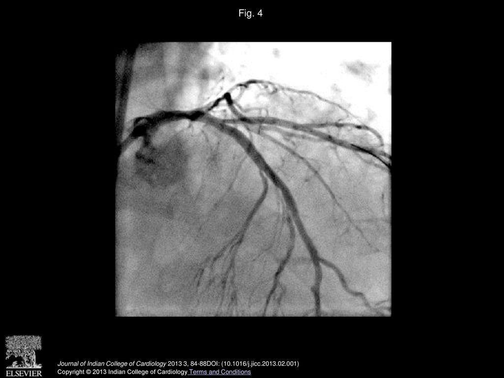 Fig. 4 Final result after stenting LAD and POBA to Dg –