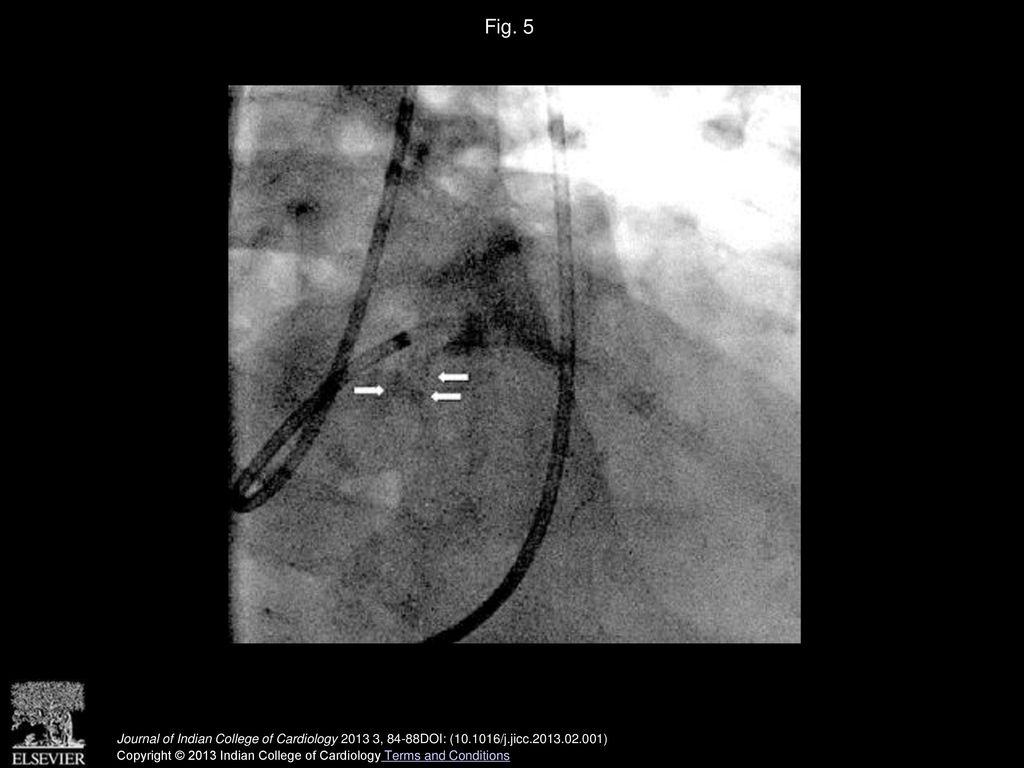 Fig. 5 Left main stent overhanging into the aorta (arrows), guide catheter is engaged through a strut of the stent –