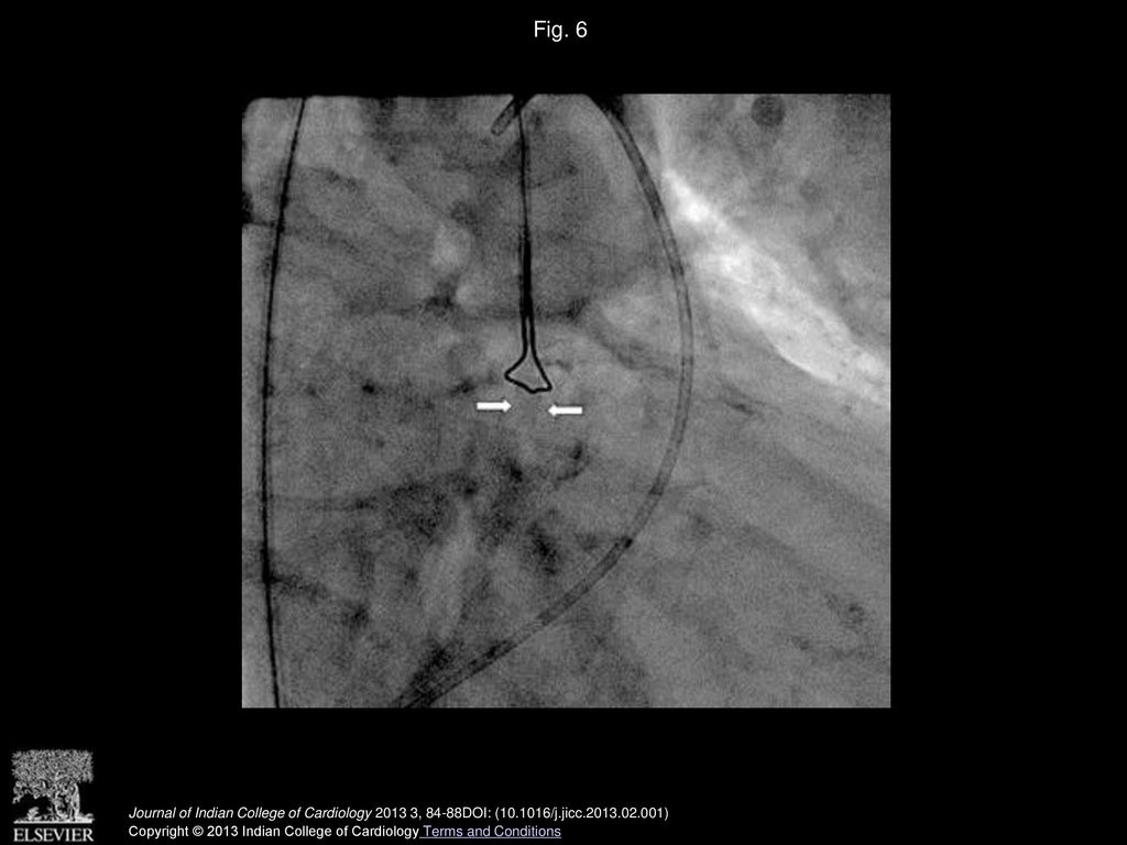 Fig. 6 Stent (arrows) extraction with the snare supported with the guide catheter –