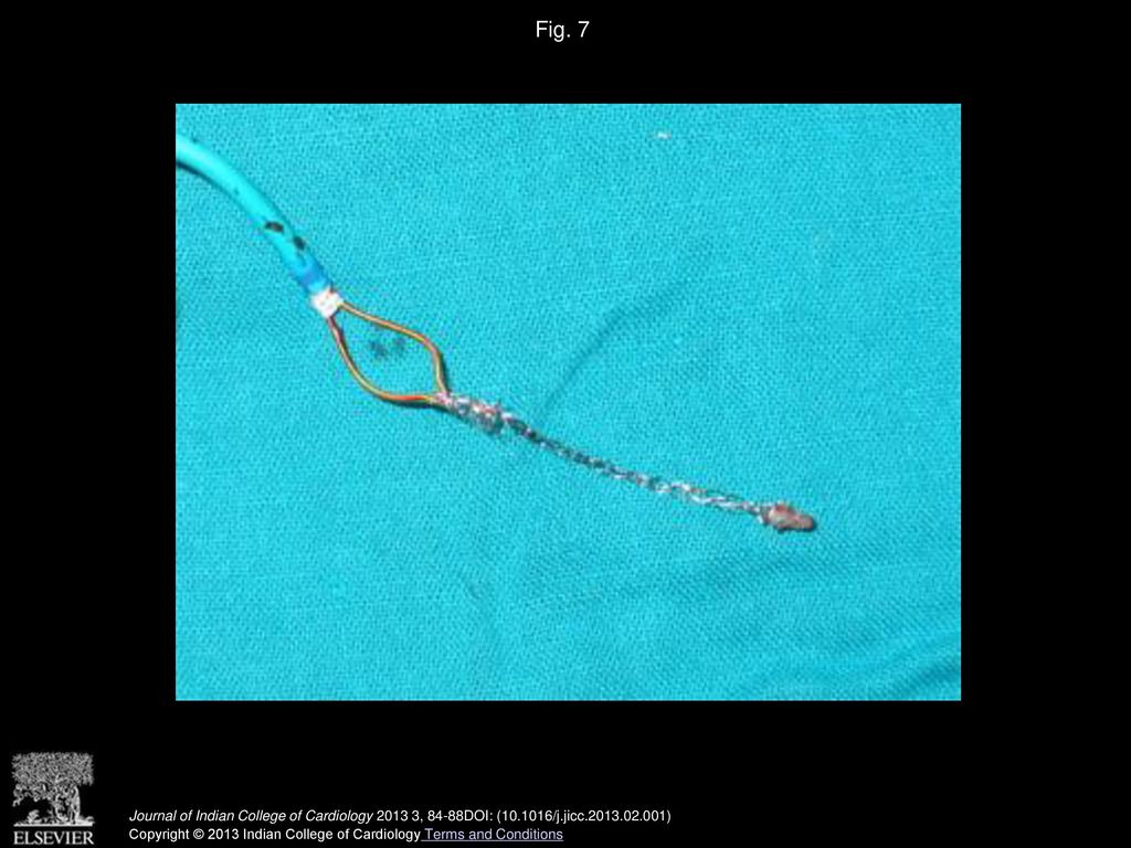 Fig. 7 Picture of the extracted stent with some tissue at one end.