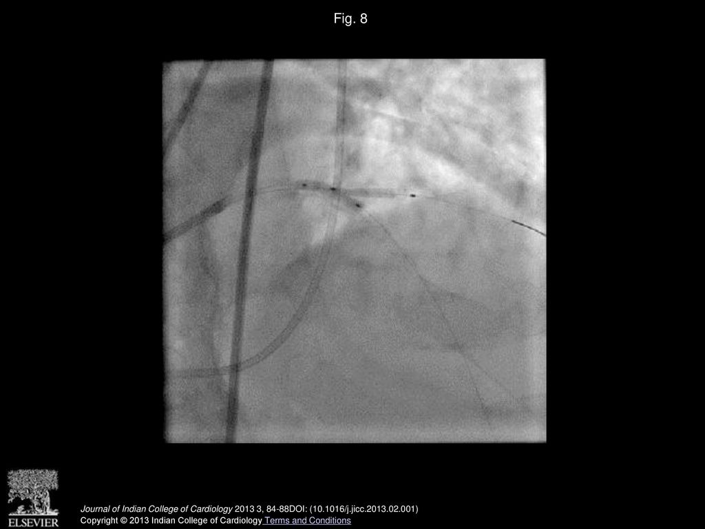 Fig. 8 Stent deployed in diagonal and balloon inflated in LAD (Tap Technique) –