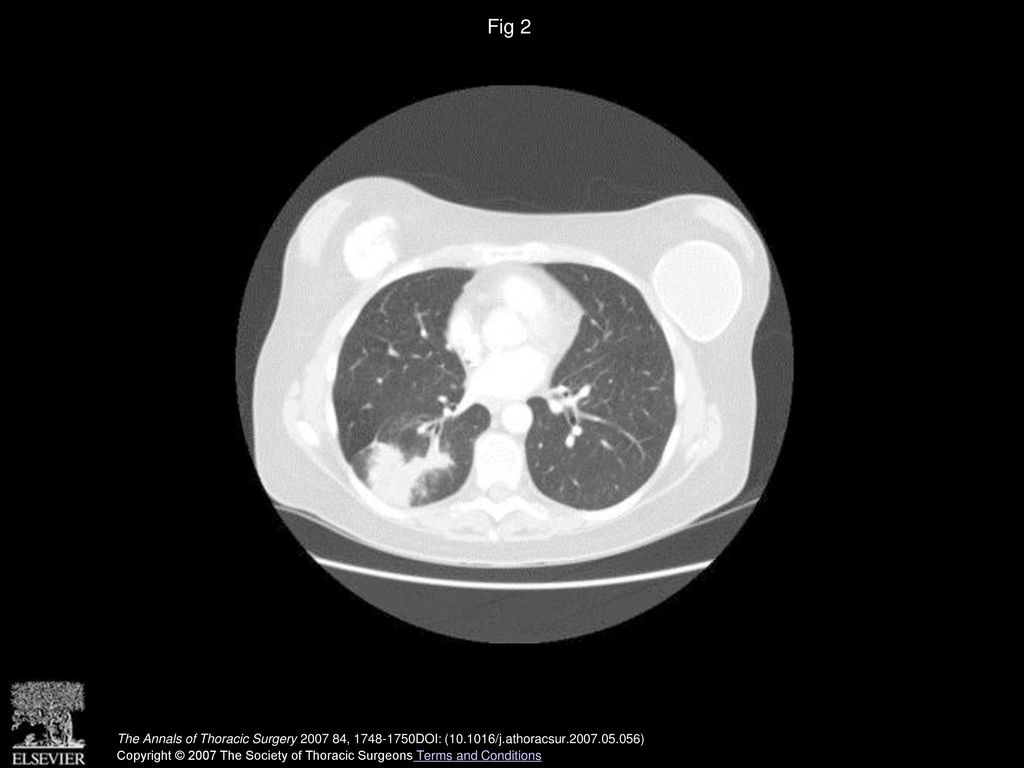 Fig 2 Computed tomographic chest scan shows transverse section with lung window settings showing mass of the right lower lobe.