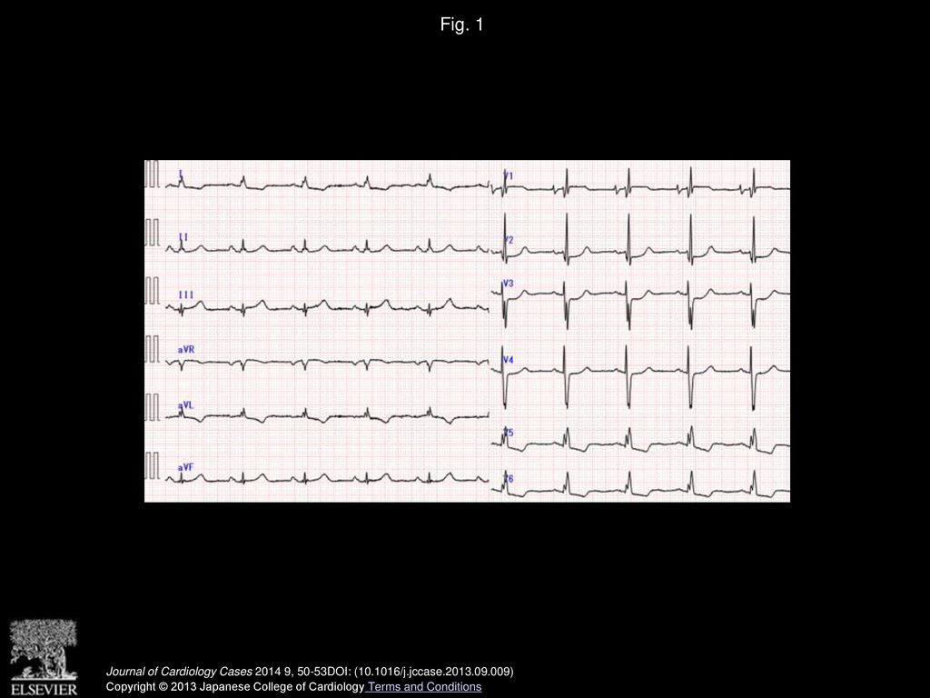 Fig. 1 A 12-lead electrocardiogram revealed a left-bundle branch block and QRS duration of 120ms.
