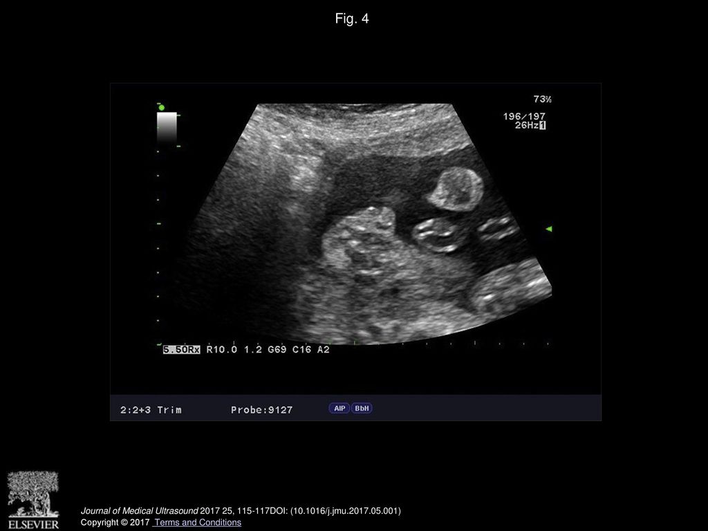 Fig. 4 Unobvious Tulip sign , 23 weeks of gestation.