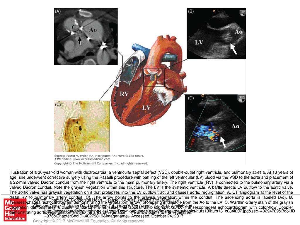 Illustration of a 36-year-old woman with dextrocardia, a ventricular septal defect (VSD), double-outlet right ventricle, and pulmonary atresia. At 13 years of age, she underwent corrective surgery using the Rastelli procedure with baffling of the left ventricular (LV) blood via the VSD to the aorta and placement of a 22-mm valved Dacron conduit from the right ventricle to the main pulmonary artery. The right ventricle (RV) is connected to the pulmonary artery via a valved Dacron conduit. Note the grayish vegetation within this structure. The LV is the systemic ventricle. A baffle directs LV outflow to the aortic valve. The aortic valve has grayish vegetation on it that prolapses into the LV outflow tract and causes aortic regurgitation. A. CT angiogram at the level of the distal RV to pulmonary artery conduit (C). The arrow points to the grayish vegetation within the conduit. The ascending aorta is labeled (Ao). B. Transesophageal echocardiogram demonstrating the vegetation (arrow) prolapsing in diastole from the Ao to the LV. C. Warthin-Starry stain of the grayish vegetation demonstrates a cluster of Bartonella henselae that appear as black specks. D. Transesophageal echocardiogram with color-flow Doppler demonstrating aortic regurgitation around the area of vegetation. The arrow points to the vegetation.