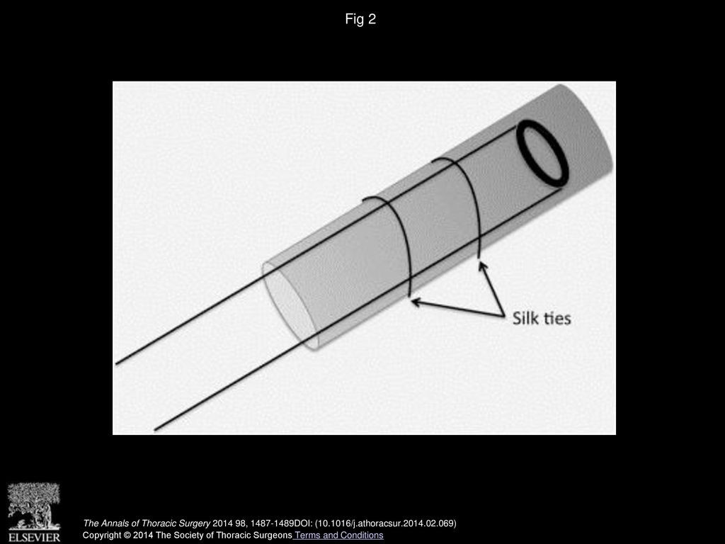 Fig 2 Diagram showing securing of cannula into graft.