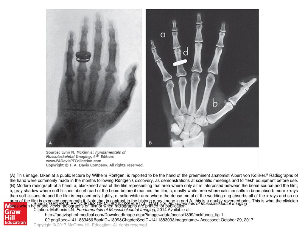 (A) This image, taken at a public lecture by Wilhelm Röntgen, is reported to be the hand of the preeminent anatomist Albert von Kölliker.8 Radiographs of the hand were commonly made in the months following Röntgen s discovery, as demonstrations at scientific meetings and to test equipment before use. (B) Modern radiograph of a hand: a, blackened area of the film representing that area where only air is interposed between the beam source and the film; b, gray shadow where soft tissues absorb part of the beam before it reaches the film; c, mostly white area where calcium salts in bone absorb more x-rays than soft tissues do and the film is exposed only lightly; d, solid white area where the dense metal of the wedding ring absorbs all of the x-rays and so no area of the film is exposed underneath it. Note that in contrast to the historic x-ray image in part A, this is a doubly reversed print. This is what the clinician sees when he or she views radiographs on film or when radiographs are printed for publication.