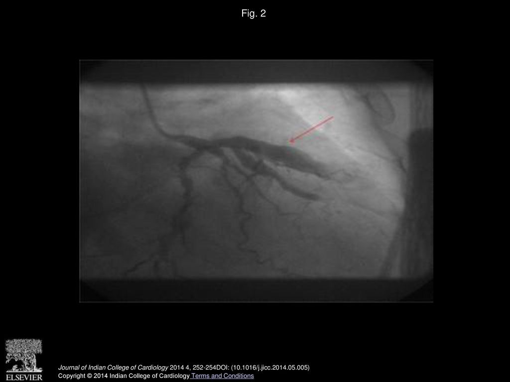 Fig. 2 RAO caudal view left system angiogram showing ectatic proximal to mid LAD.
