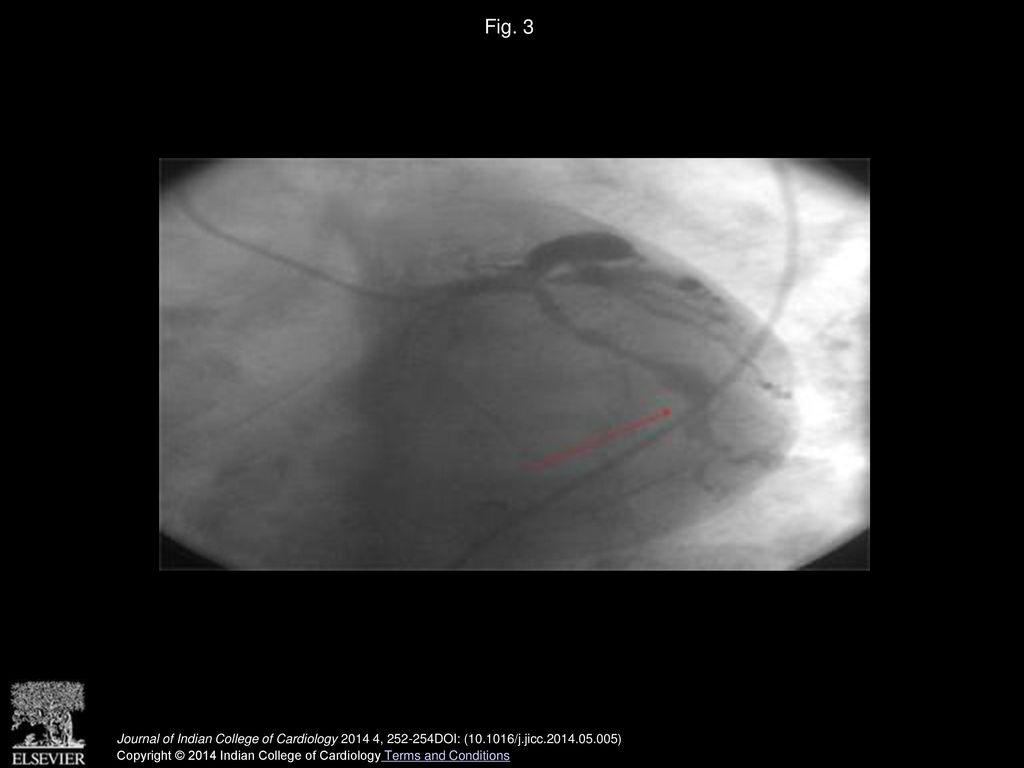 Fig. 3 LAO caudal view left system angiogram showing localised ectasia in distal LCX.