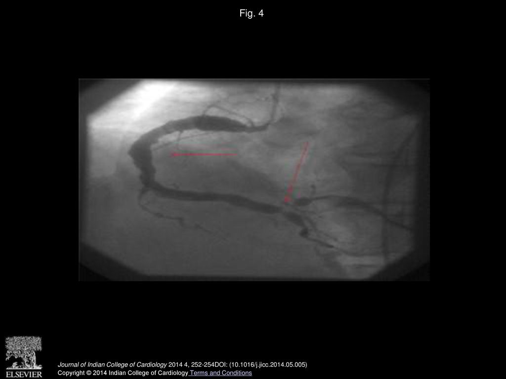 Fig. 4 LAO view right system angiogram showing diffuse ectasia of RCA and stenosis at bifurcation.