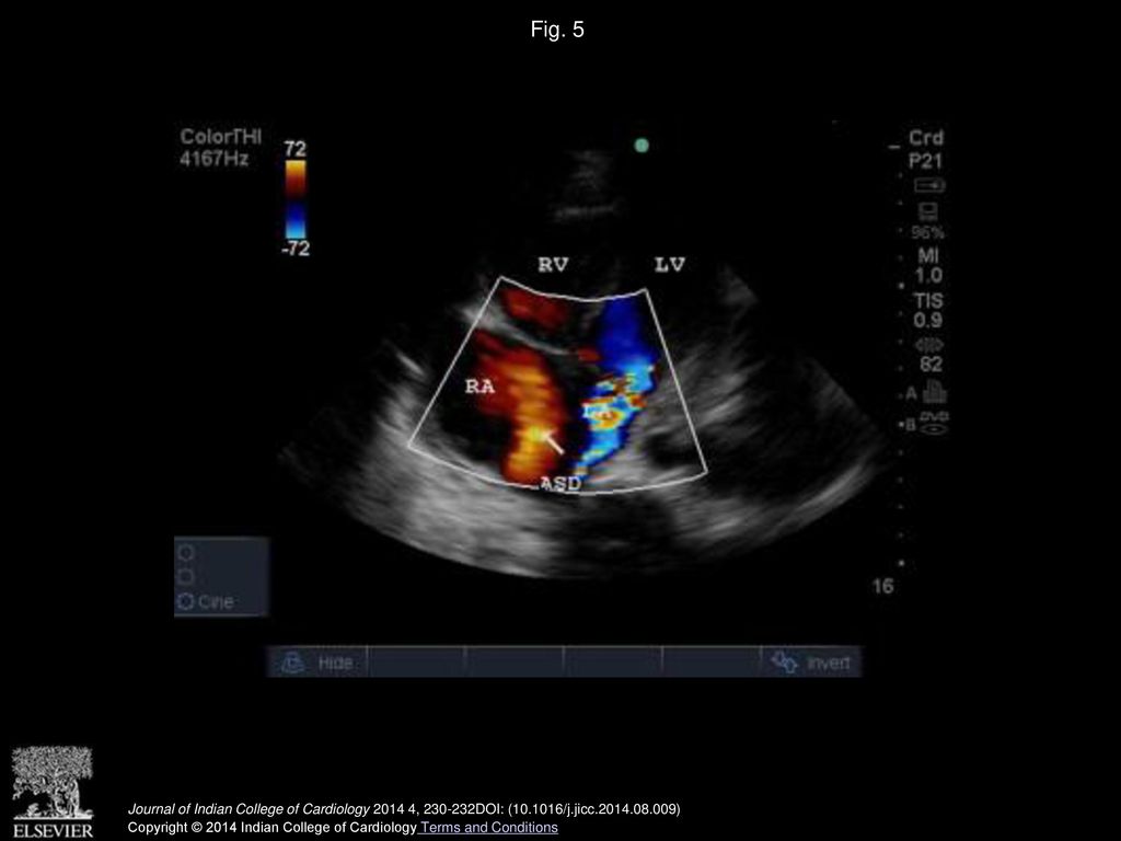 Fig. 5 Colour Doppler echocardiography showing eccentric jet of severe MR and left to right shunt through the ASD.