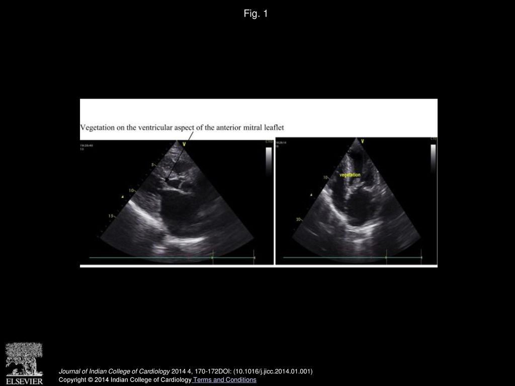Fig. 1 Vegetation on the ventricular aspect of the anterior mitral leaflet.