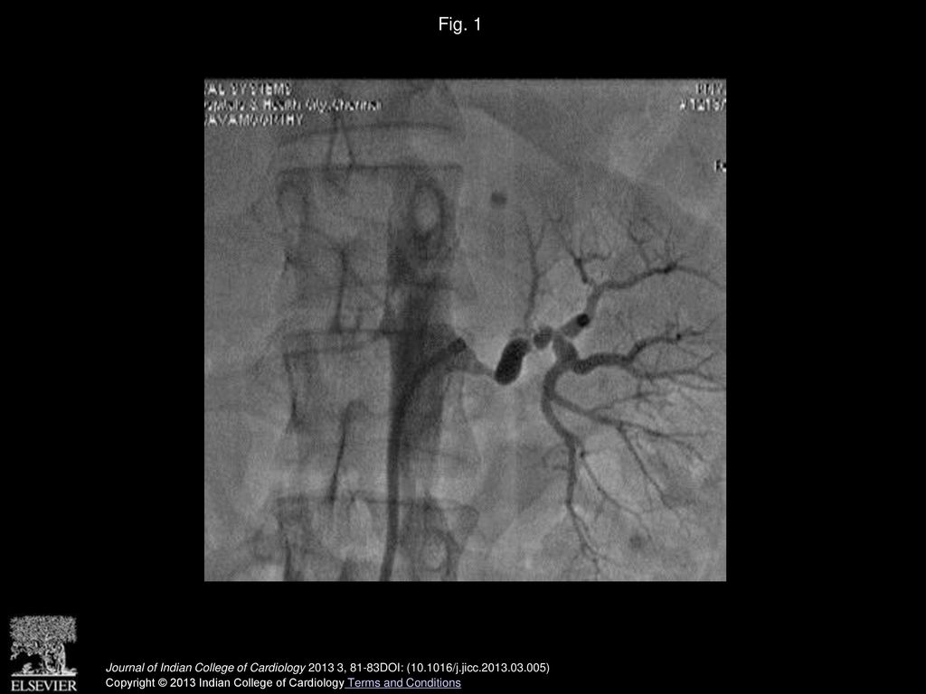 Fig. 1 Beadingof distal renal artery with stenosis of mid segment and distal bifurcation. Right renal artery is faintly seen.