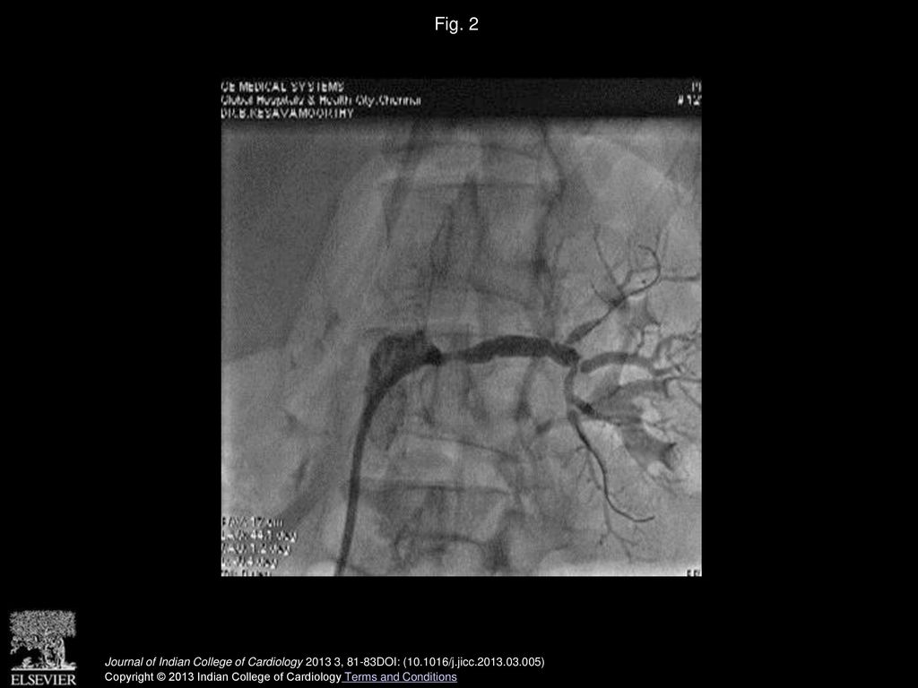 Fig. 2 Post stenting severe pinching of upper lobe artery.