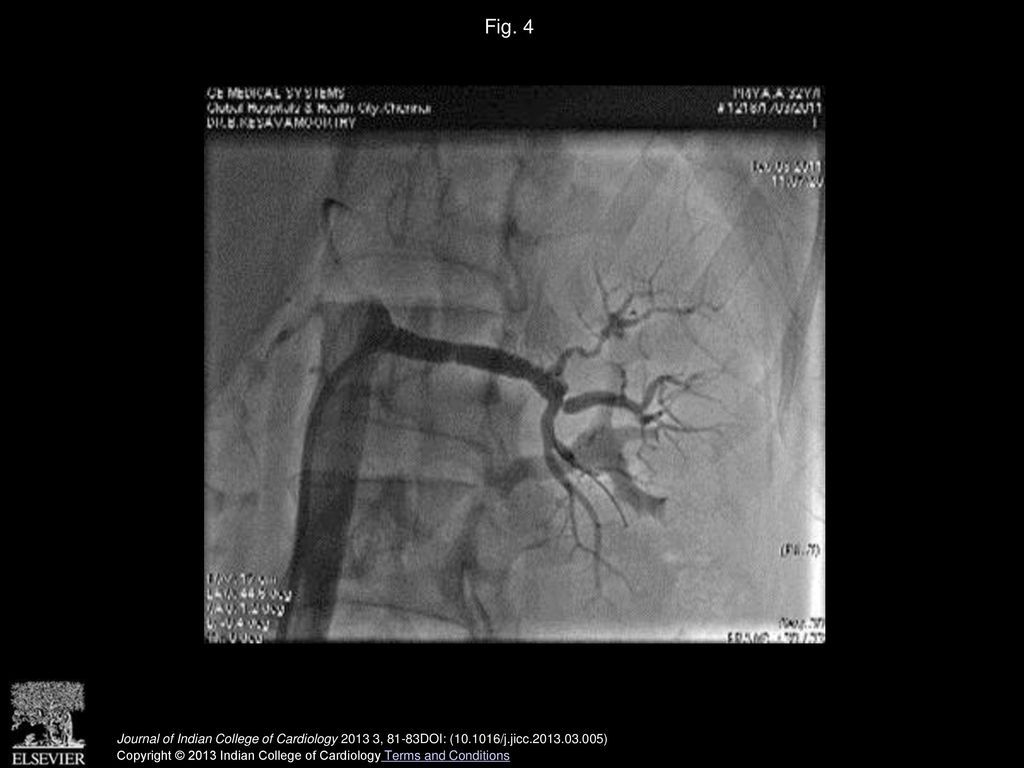 Fig. 4 Post PTRA final angiogram [1].