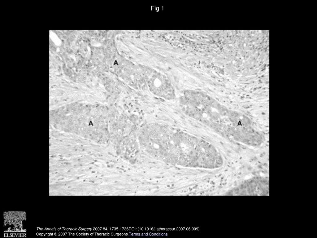 Fig 1 Representative hematoxylin and eosin section of squamous cell carcinoma (A) within pericardial tissue (×200).