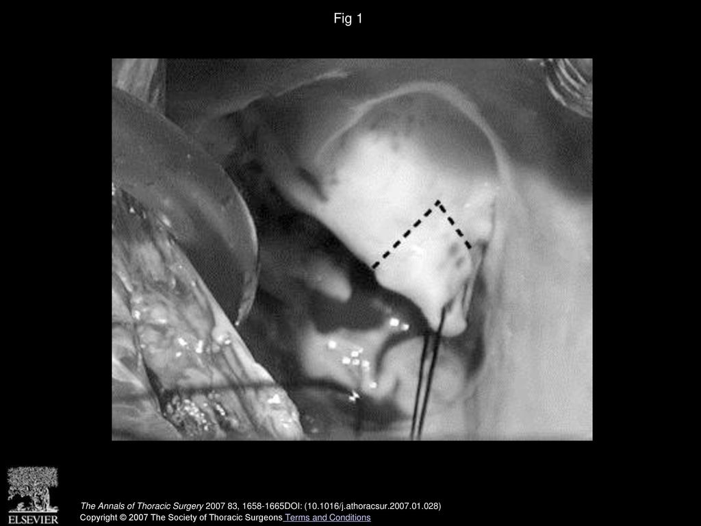 Fig 1 Prolapse of A2, before repair.
