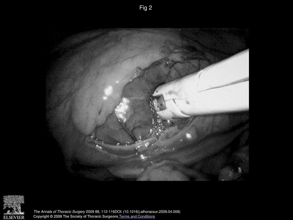 Fig 2 Direct placement is shown of active fixation pacemaker leads.