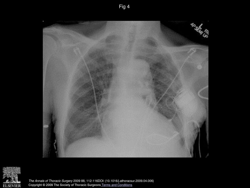 Fig 4 Chest roentgenogram shows the implantable cardioverter-defibrillators device coil.