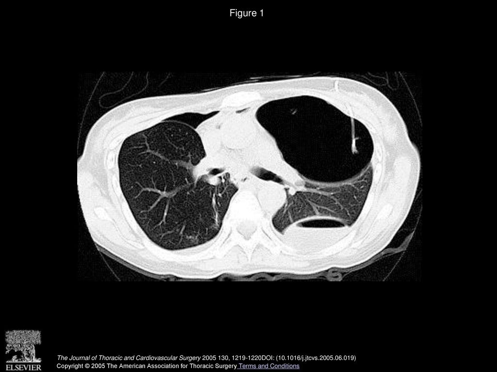 Figure 1 Left hydropneumothorax after bilateral living-donor lobar lung transplantation (patient 2).