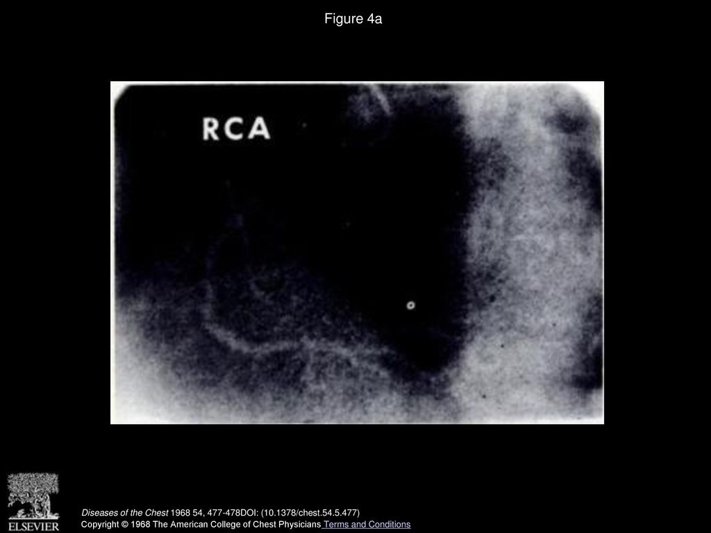 Figure 4a (upper). Early frame from a right sided injection showing normal right coronary artery (RCA) and a large diagonal branch.