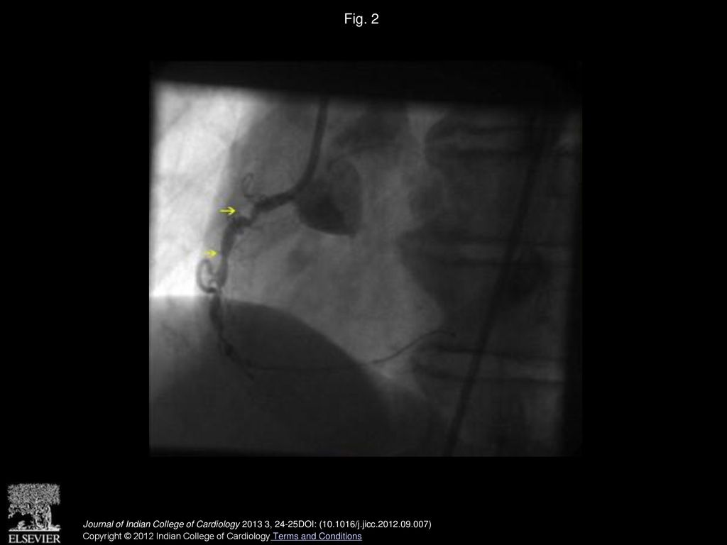 Fig. 2 Appearance of two peeudo narrowings (arrows) proximal to the initial lesion.