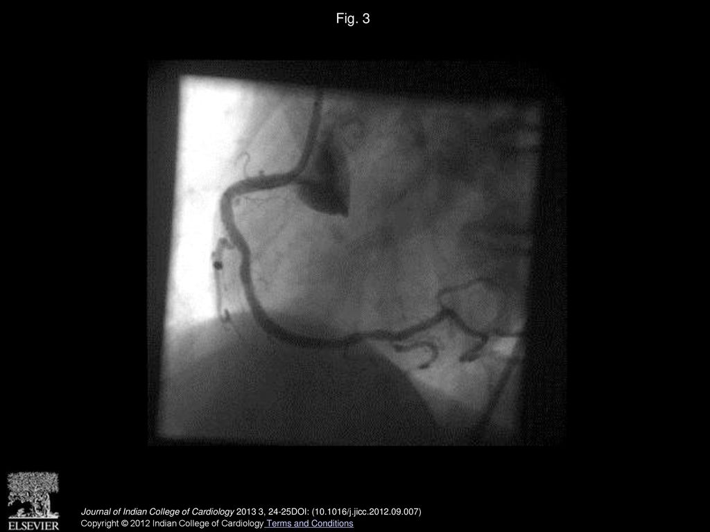 Fig. 3 Disappearance of the pseudo narrowings following withdrawal of guide wire from the coronary artery.