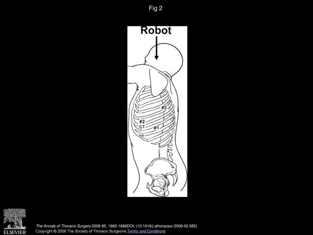Fig 2 Port placement for robotic lobectomy in the left side of the chest. Numbers 1, 2, 3 indicate incisions. (CT = chest tube.)