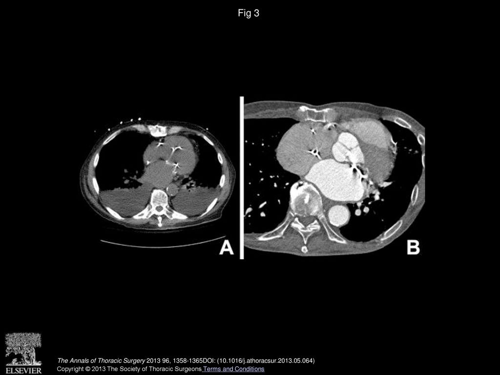 Fig 3 (A) Computed tomography scans of a patient at low risk and (B) a patient at high risk for intraoperative injury.