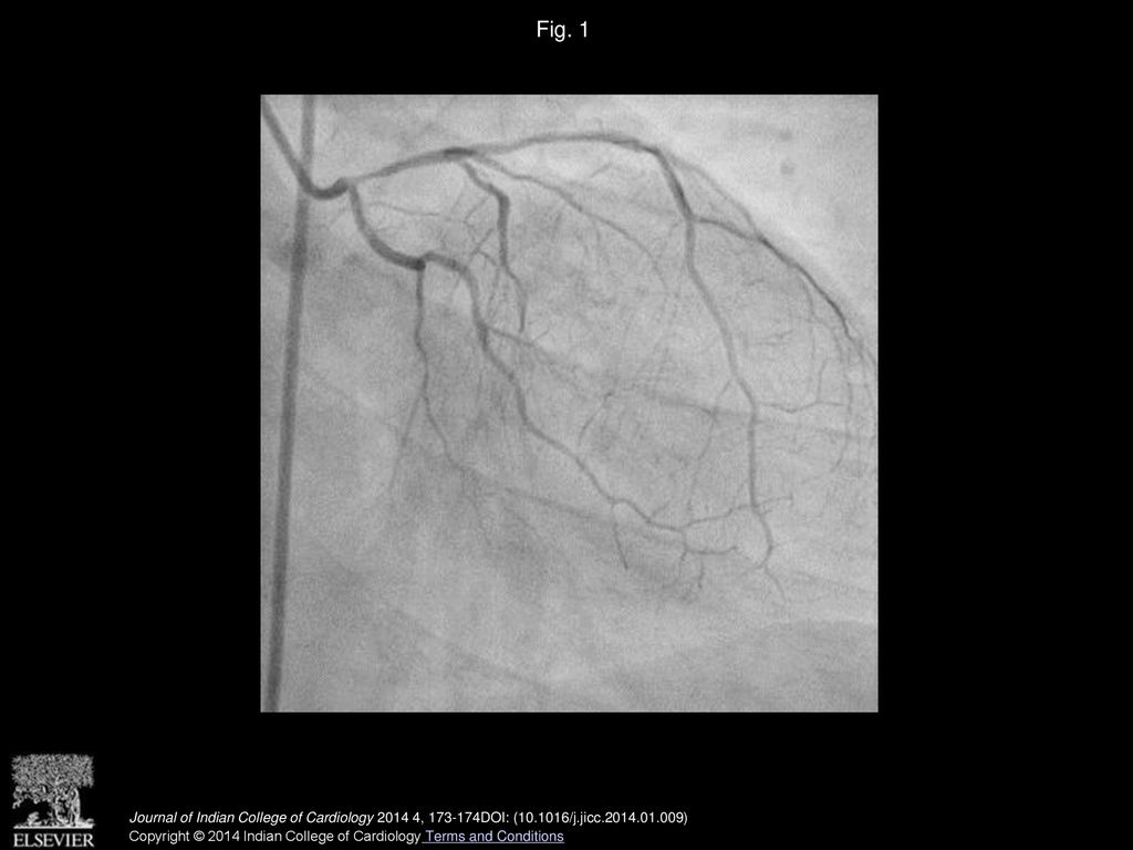 Fig. 1 RAO Caudal view showing ostial LAD spasm.
