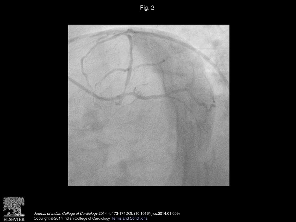 Fig. 2 LAO Caudal view showing ostial LAD spasm.