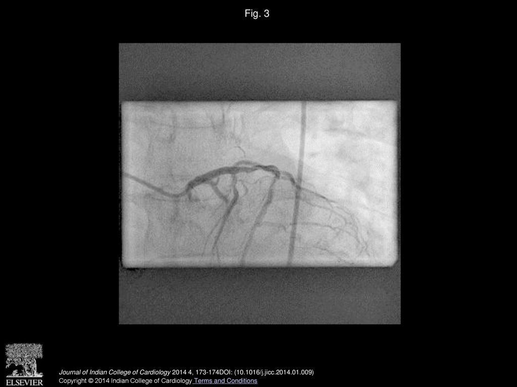 Fig. 3 RAO Caudal view showing normal coronaries following nitroglycerine intracoronary.