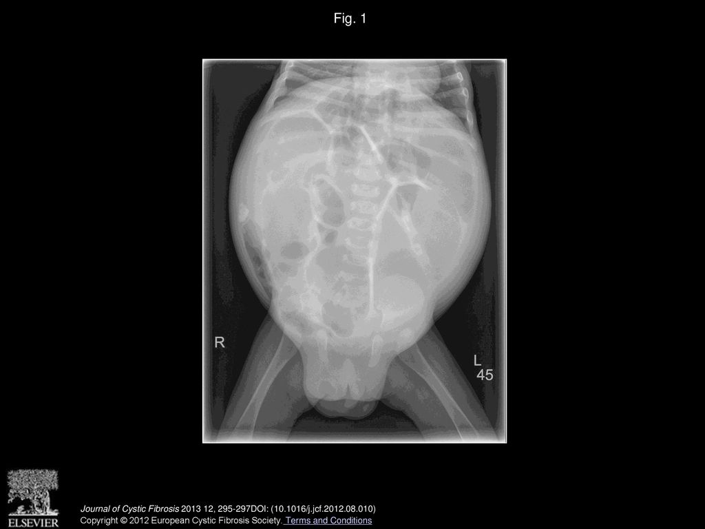 Fig. 1 Abdominal X ray at 16weeks of age. Note features of bowel obstruction and calcification within the abdomen and in the left scrotum.