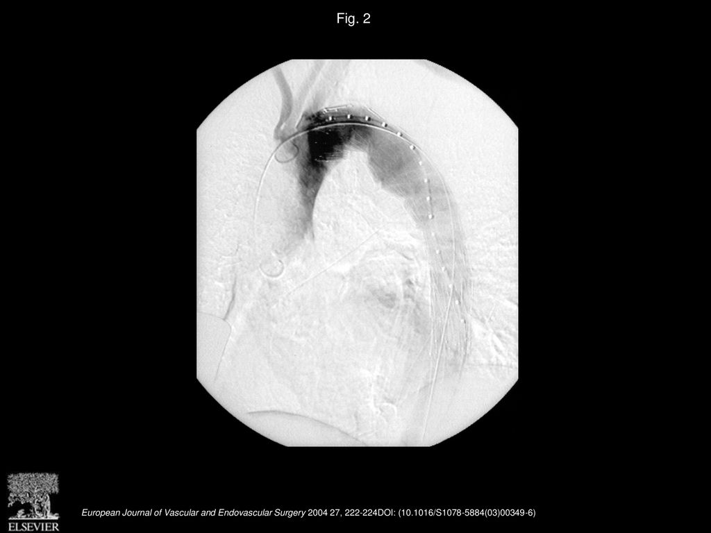 Fig. 2 Completion angiography following stent-grafting showing complete exclusion of TAA and occlusion of origin of arteria lusoria.
