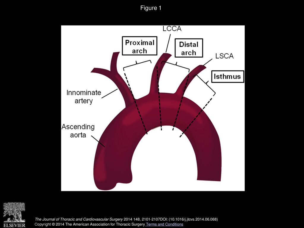 Figure 1 Aortic arch anatomy. LCCA, Left common carotid artery; LSCA, left subclavian artery.