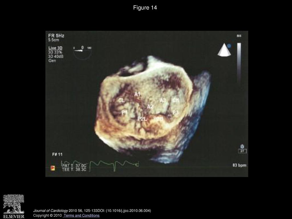 Figure 14 Real-time 3D image of the mitral valve anatomy as visualized en face from the left atrial view.